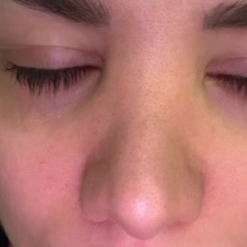 Başarısız Burun Estetiği Sonrası Asimetri Ve Şişlik Sorunu