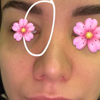 Başarısız Burun Estetiği Sonrası Asimetri Ve Şişlik Sorunu