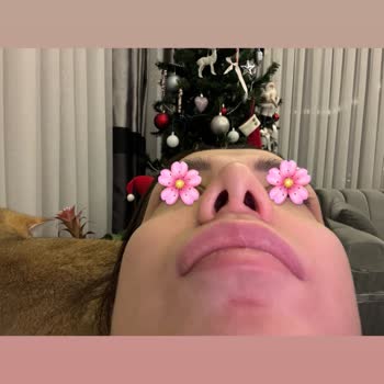 Başarısız Burun Estetiği Sonrası Asimetri Ve Şişlik Sorunu