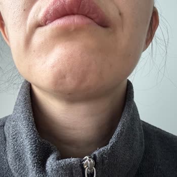 Purest C Vitamini Serum Cildimde Yanma Ve Şişlik Yaptı