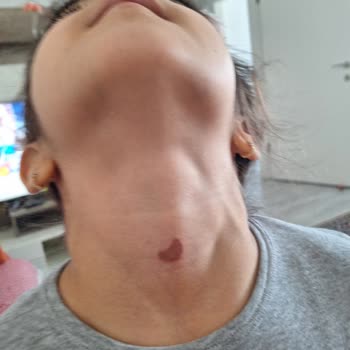 Isana Deodorant Cildinde Yanık Oluşturdu