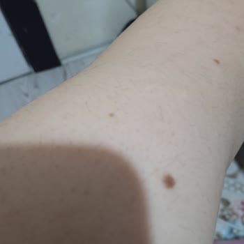 Livangel Güzellik Merkezi Lazerden Hiçbir Sonuç Alamadım