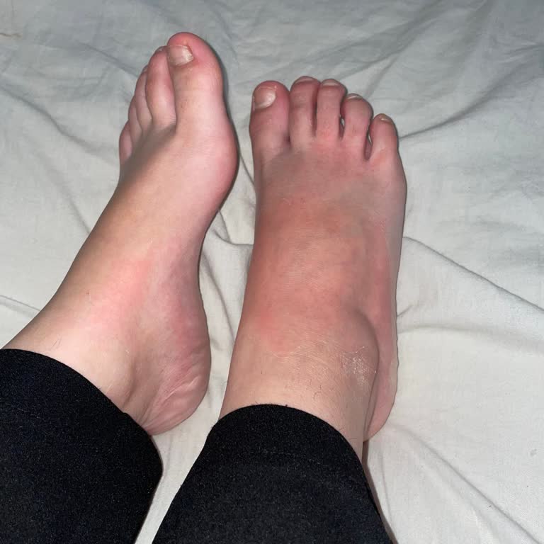 Bee Beauty Ayak Maskesi Kullanımı Sonrası Ciddi Tahriş Sorunu