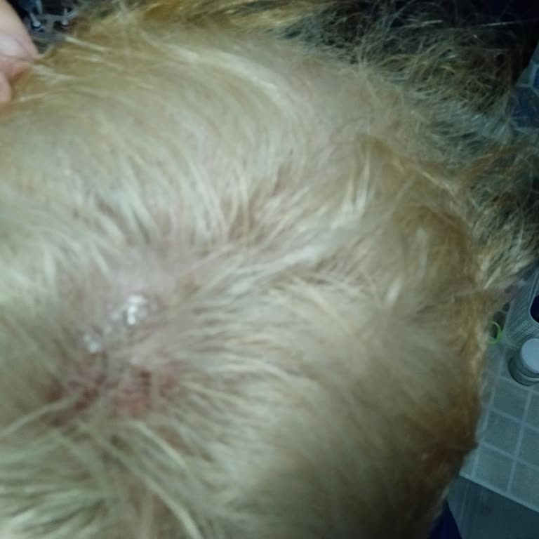 Saç Boyası Kullanımı Sonrası Ciddi Yanma Ve Tahriş