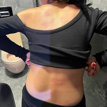 Yanlış Hizmet Sonucu Ciddi Yanıklar Ve Müşteri Memnuniyetsizliği