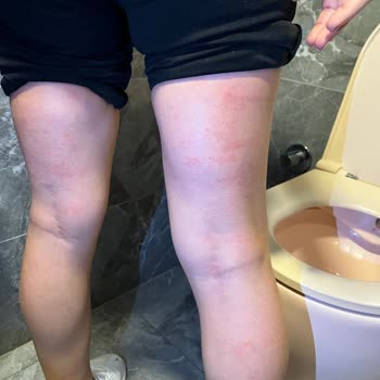 Yanlış Hizmet Sonucu Ciddi Yanıklar Ve Müşteri Memnuniyetsizliği