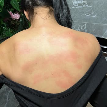 Yanlış Hizmet Sonucu Ciddi Yanıklar Ve Müşteri Memnuniyetsizliği