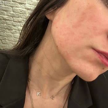 La Roche-Posay Hyalu B5 Serumu Kullanımında Alerjik Reaksiyon Deneyimi