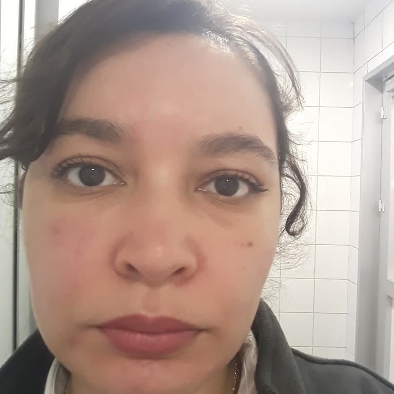 Severe Breakouts and Swelling After Using Sinoz Face Wash Gel