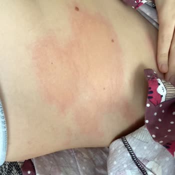 Yumoş Ekstra Sakura Alerjik Reaksiyona Sebep Oldu