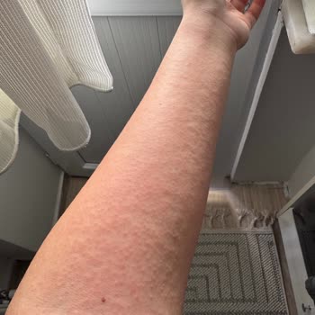 Alerjik Reaksiyon Yapan Vücut Losyonu