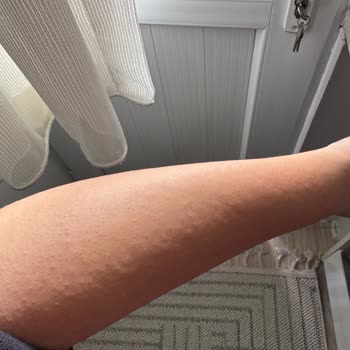 Alerjik Reaksiyon Yapan Vücut Losyonu