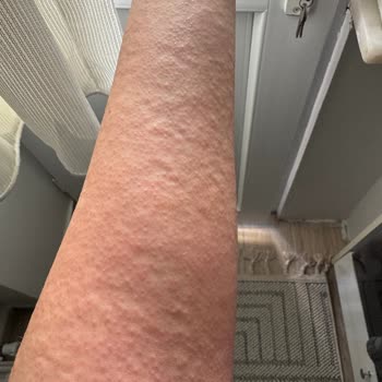 Alerjik Reaksiyon Yapan Vücut Losyonu