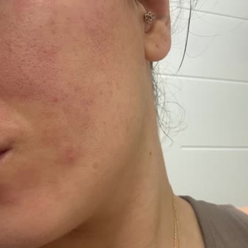 Rossmann Alterra C Vitamini Serum Mağduriyeti