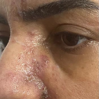 Yanlış Tıbbi İşlem Sonrası Hayati Tehlike