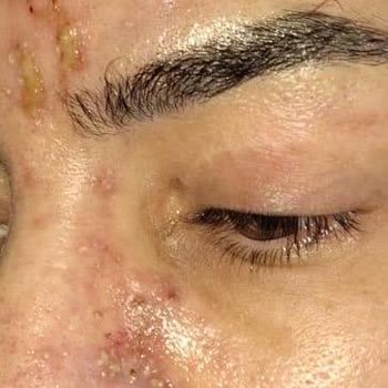 Yanlış Tıbbi İşlem Sonrası Hayati Tehlike