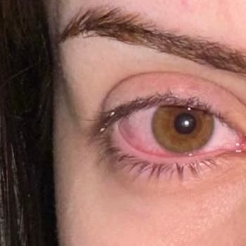 Emsal Doğan Güzellik Merkezi İpek Kirpik Uygulamasında Yaşanan Sorunlar Ve İlgisizlik