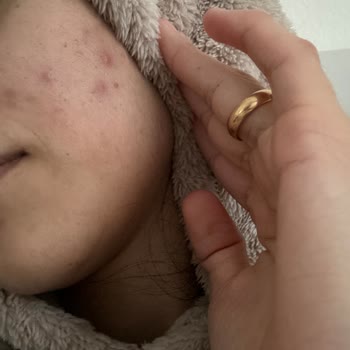 Trendyol'dan Aldığım Ürün Cildimi Tahriş Etti
