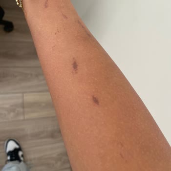 Suit Çayyolu'nda Lazer Yanığı Ve Güven Sorunu