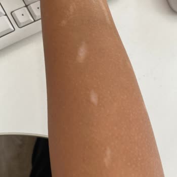 Suit Çayyolu'nda Lazer Yanığı Ve Güven Sorunu