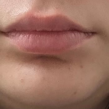 Dr. Ömer Aşık Dudak Dolgusu Mağduriyeti Ve İlgisizlik