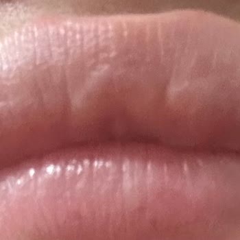 Dr. Ömer Aşık Dudak Dolgusu Mağduriyeti Ve İlgisizlik