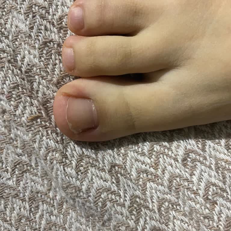 Pedikür Sonrası Batık Tırnak Sorunu