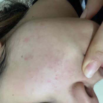 Yves Rocher Ürünleri Cildimi Mahvetti