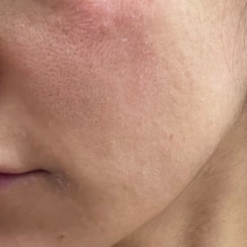 Yves Rocher Ürünleri Cildimi Mahvetti: Para İadesi Talep Ediyorum