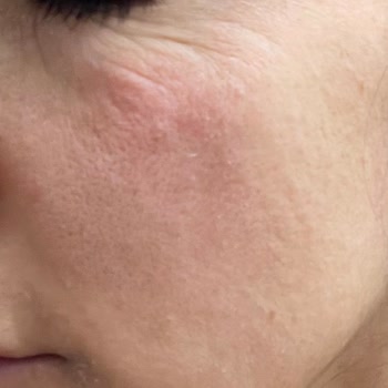 Yves Rocher Ürünleri Cildimi Mahvetti: Para İadesi Talep Ediyorum