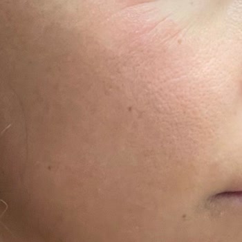 Yves Rocher Ürünleri Cildimi Mahvetti: Para İadesi Talep Ediyorum