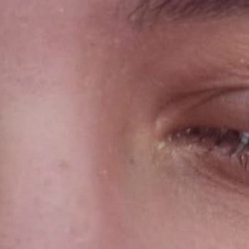 Doktor Öz Göz Lazer Ameliyatında İlgisizlik Ve Sağlık Riski