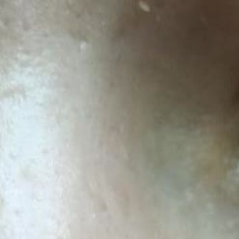 Doktor Öz Göz Lazer Ameliyatında İlgisizlik Ve Sağlık Riski