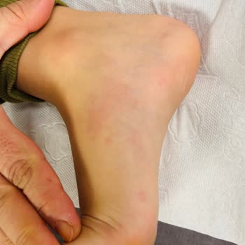 Kimyasal Kaplama Sonrası Alerjik Reaksiyon Şoku