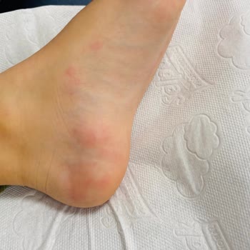 Kimyasal Kaplama Sonrası Alerjik Reaksiyon Şoku