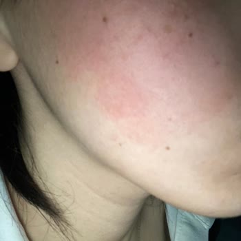 Bioderma Pigmentbio C-Serum: Yanma Ve Kızarıklık Sorunu