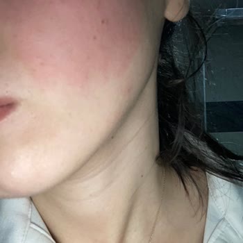 Bioderma Pigmentbio C-Serum: Yanma Ve Kızarıklık Sorunu