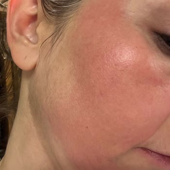 Bioderma Pigmentbio C-Serum: Yanma Ve Kızarıklık Sorunu