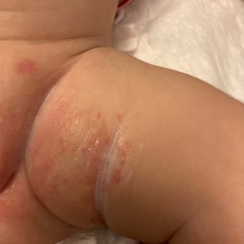 Molfix Bebek Bezi Cilt Sorunlarına Yol Açtı