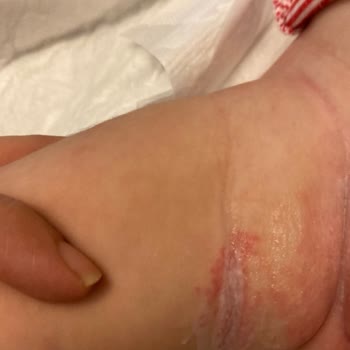 Molfix Bebek Bezi Cilt Sorunlarına Yol Açtı