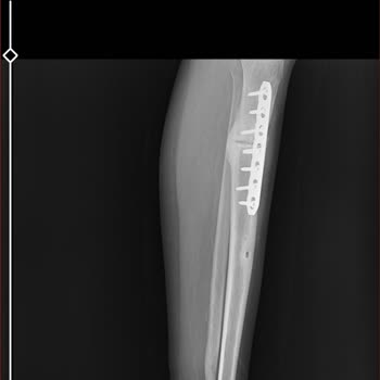 Hayal Kırıklığı Ve Mağduriyet: Başarısız Ameliyatlar Sonrası Zorlaşan Yaşam