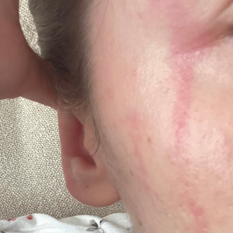 Yanlış Ambalaj Nedeniyle Alerjik Reaksiyon