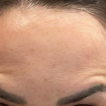 Estpoint Kliniğinde Başarısız Botox Deneyimi Ve İade Sorunu