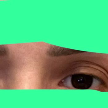 Estpoint Kliniğinde Başarısız Botox Deneyimi Ve İade Sorunu