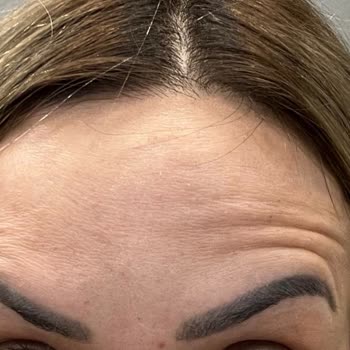 Estpoint Kliniğinde Başarısız Botox Deneyimi Ve İade Sorunu