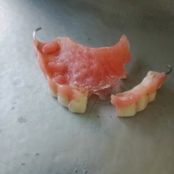 Protez Dişimin Tamiri Sırasında Yaşadığım Mağduriyet