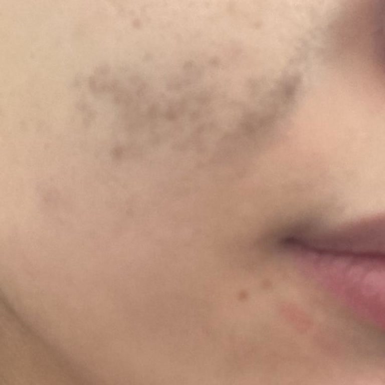 Yanlış Yönlendirme Ve Etkisiz Tedavi Sonucu Artan Cilt Lekeleri