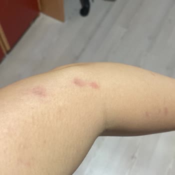 Yanıklarla Sonuçlanan Lazer İşlemi Ve İade Sorunu