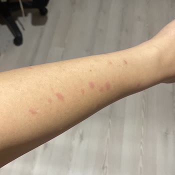 Yanıklarla Sonuçlanan Lazer İşlemi Ve İade Sorunu