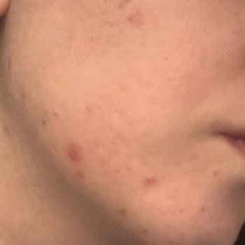 La Roche Posay Serum Beklenmedik Cilt Tepkileri Yarattı